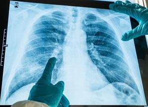 Un estudi detecta que el 40% dels pacients ingressats per covid19 tenen seqüeles en la funció pulmonar