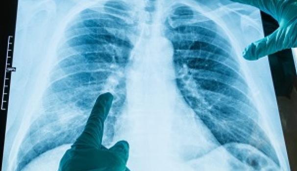 Un estudi detecta que el 40% dels pacients ingressats per covid19 tenen seqüeles en la funció pulmonar